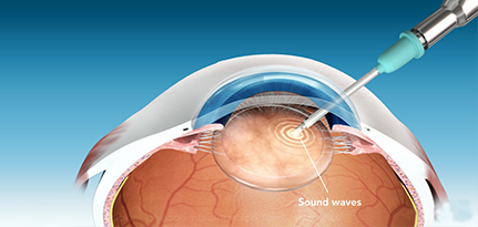 Cataract-Surgery-Indore